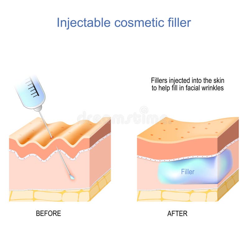 Cosmetic filler injectable. Skin with wrinkles before and after