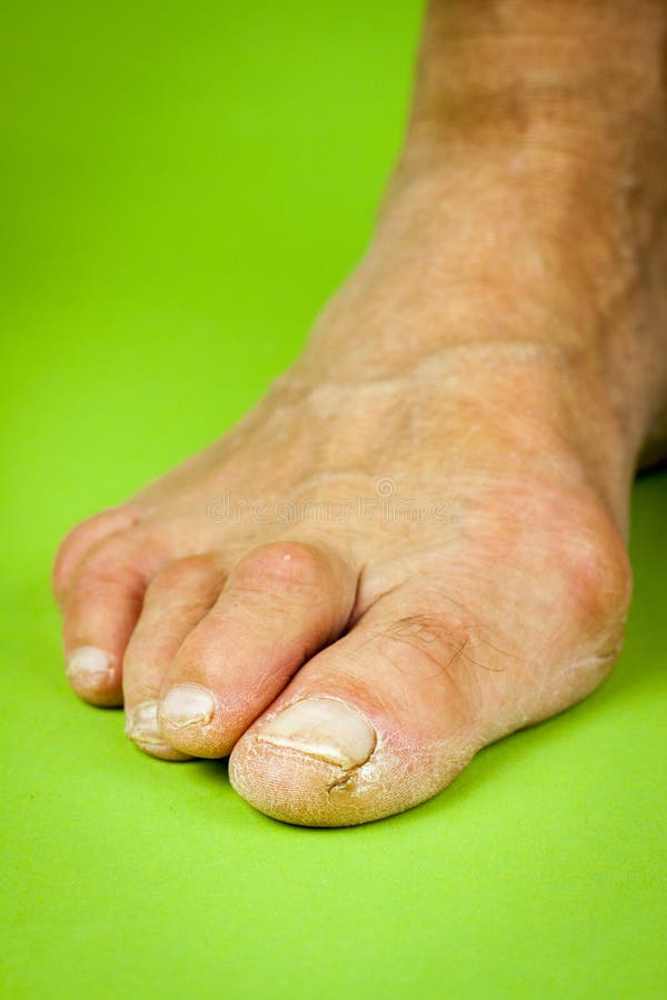 Cracked Fingertips on Green Background Stock Photo Image of fungi