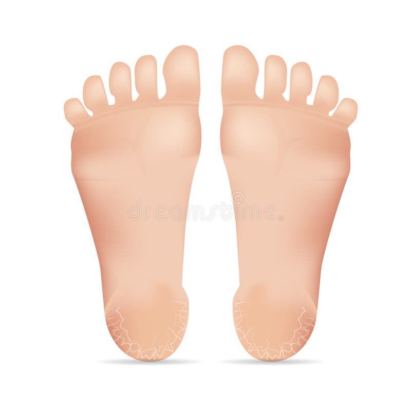 Illustration Of Healthy Feet And Feet With Cracks On The Heel Royalty Free  SVG, Cliparts, Vectors, and Stock Illustration. Image 61123618.