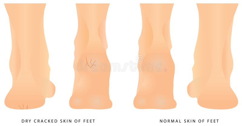 Illustration Of Healthy Feet And Feet With Cracks On The Heel Royalty Free  SVG, Cliparts, Vectors, and Stock Illustration. Image 61123618.