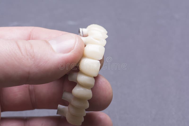 Creating Temporary Crowns on Implants Stock Photo Image of medicine