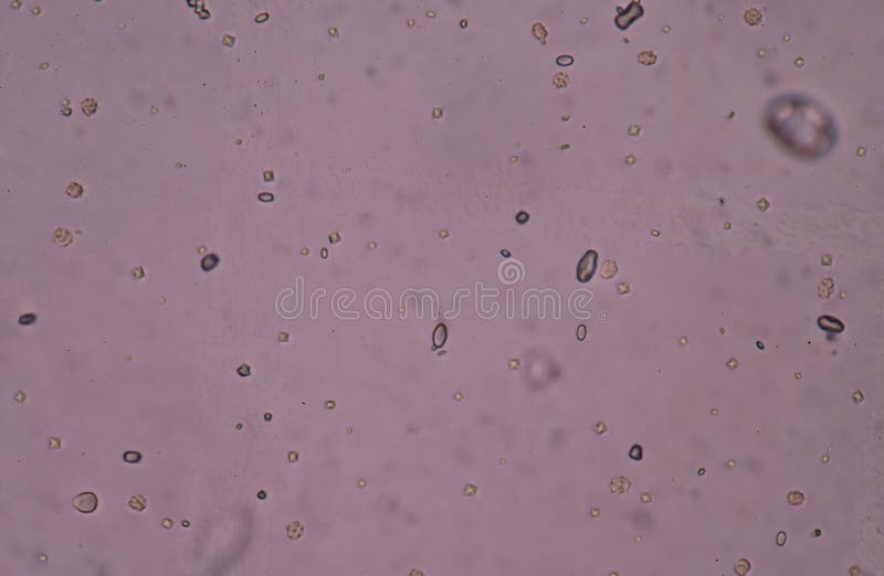 Tres Nombreux Cristaux D'oxalate De Calcium Dans Les Urines Cristal D'oxalate De Calcium En Urine Image stock - Image du asthme