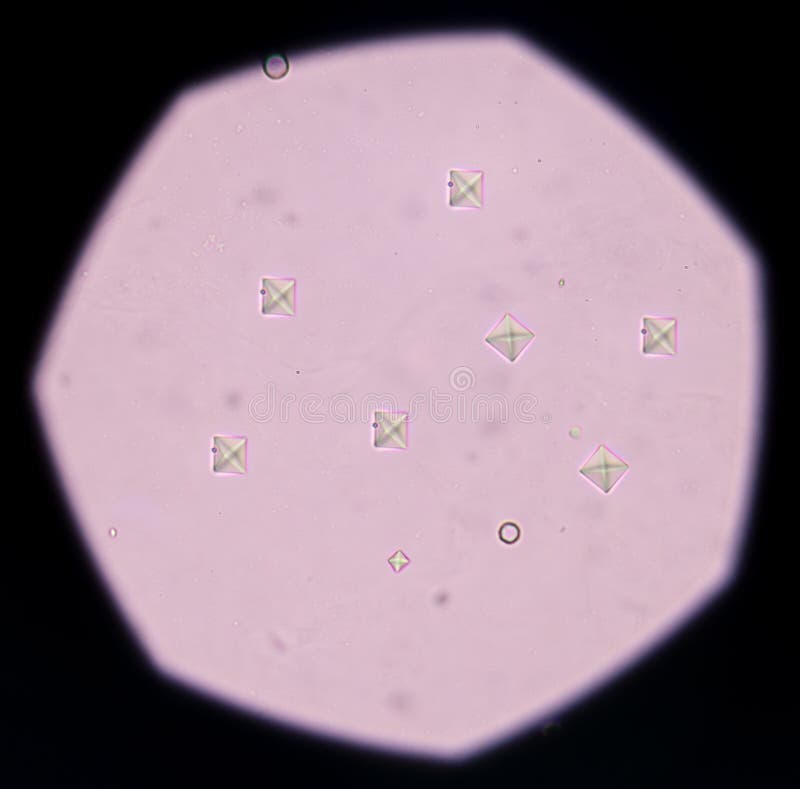 Tres Nombreux Cristaux D'oxalate De Calcium Dans Les Urines Cristal D'oxalate De Calcium Dans L'analyse D'urine Photo stock - Image