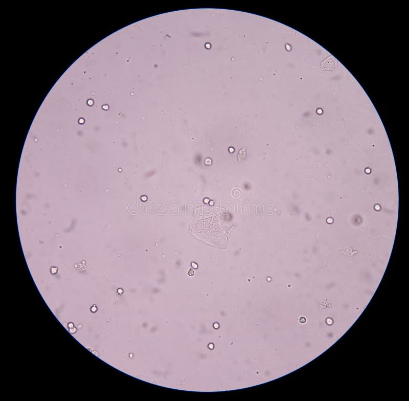 Tres Nombreux Cristaux D'oxalate De Calcium Dans Les Urines Cristal D'oxalate De Calcium En Urine Image stock - Image du asthme