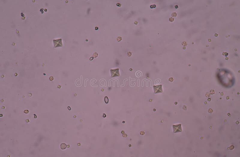 Cristalli Di Ossalato Di Calcio Nelle Urine Cristallo Dell'ossalato Del Calcio In Urina Immagine Stock - Immagine