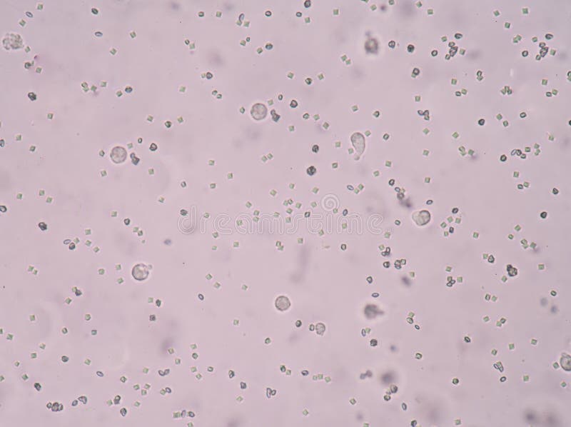 Cristalli Di Ossalato Di Calcio Nelle Urine Cristallo Dell'ossalato Del Calcio Fotografia Stock - Immagine di