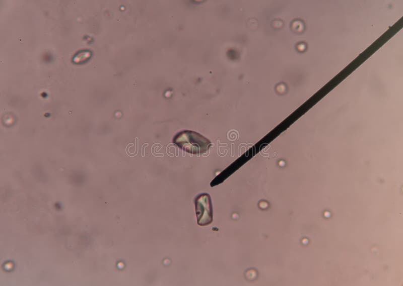 Cristalli Di Ossalato Di Calcio Nelle Urine Cristallo Dell'ossalato Del Calcio Fotografia Stock - Immagine di