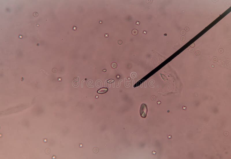 Cristalli Di Ossalato Di Calcio Nelle Urine Cristallo Dell'ossalato Del Calcio In Urina Fotografia Stock - Immagine