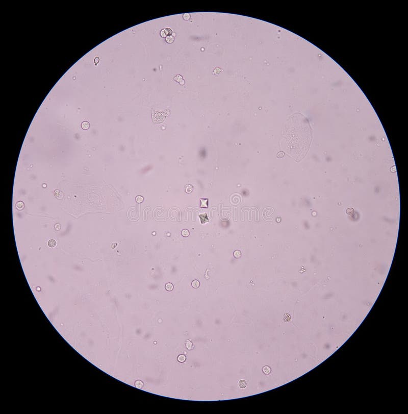 Cristalli Di Ossalato Di Calcio Nelle Urine Cristallo Dell'ossalato Del Calcio In Urina Umana Immagine Stock