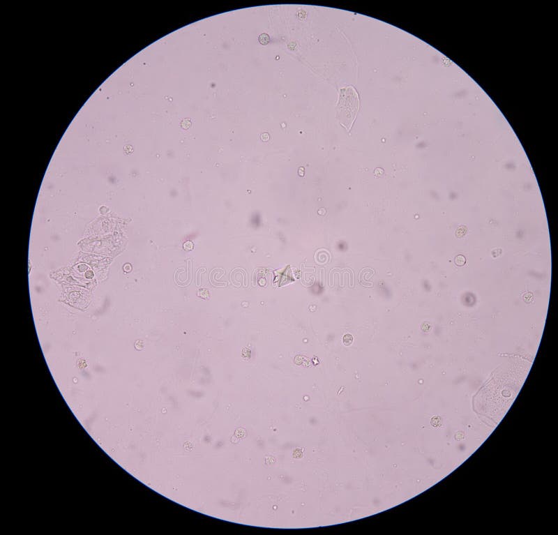 Cristalli Di Ossalato Di Calcio Nelle Urine Cristallo Dell'ossalato Del Calcio In Urina Immagine Stock - Immagine