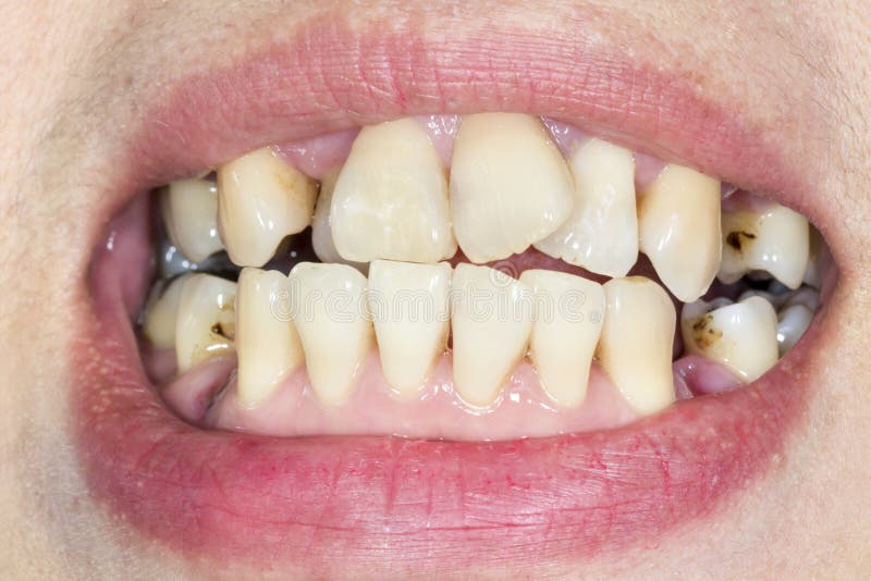 Crooked Teeth before Braces Stock Image Image of healthy, oral 49482533