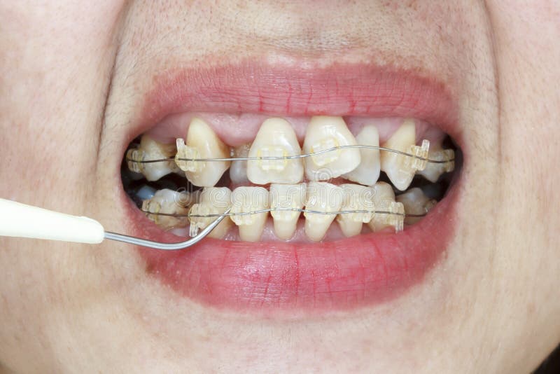 Crooked Teeth with Braces and Plaque Remover Stock Photo Image of