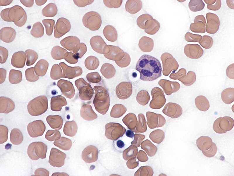 Cryptococcus in peripheral blood smear. royalty free stock image