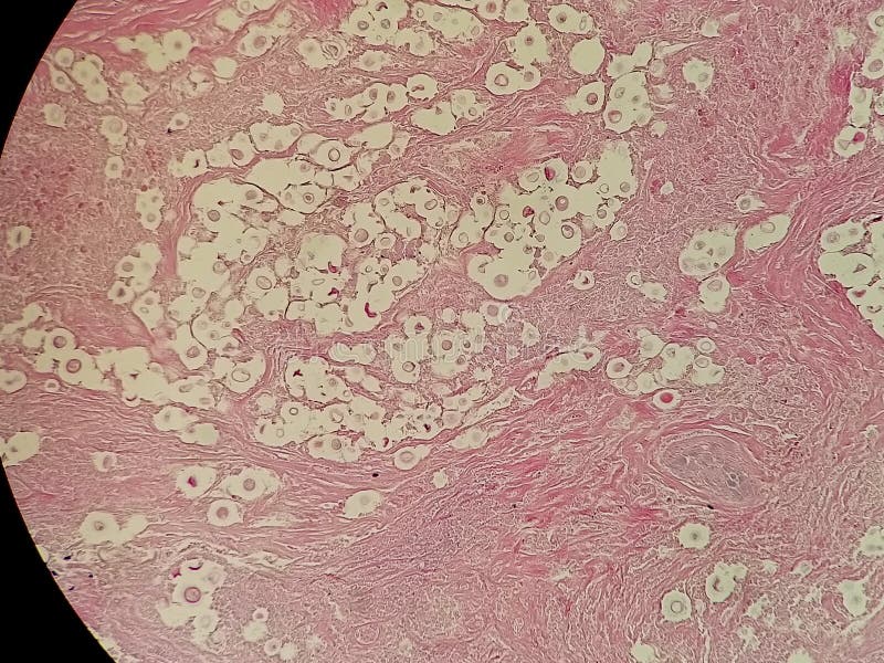 Crytpococcus neoformans stained with hematoxylin and eosin in lung biopsy stock image