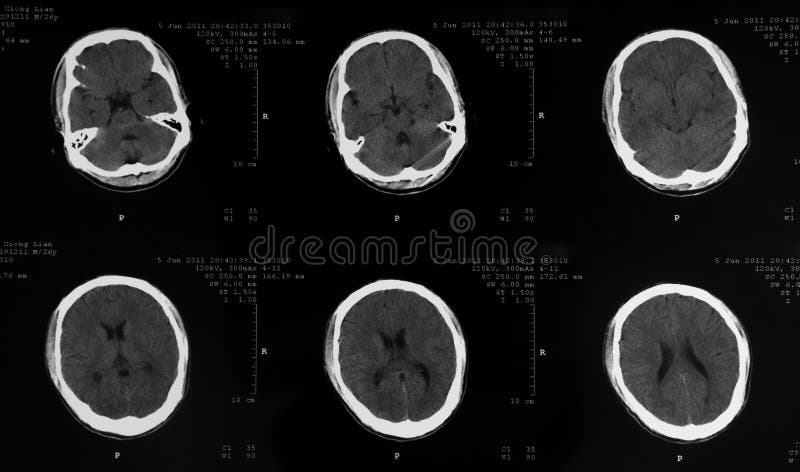 CT of human brain. CT of human brain