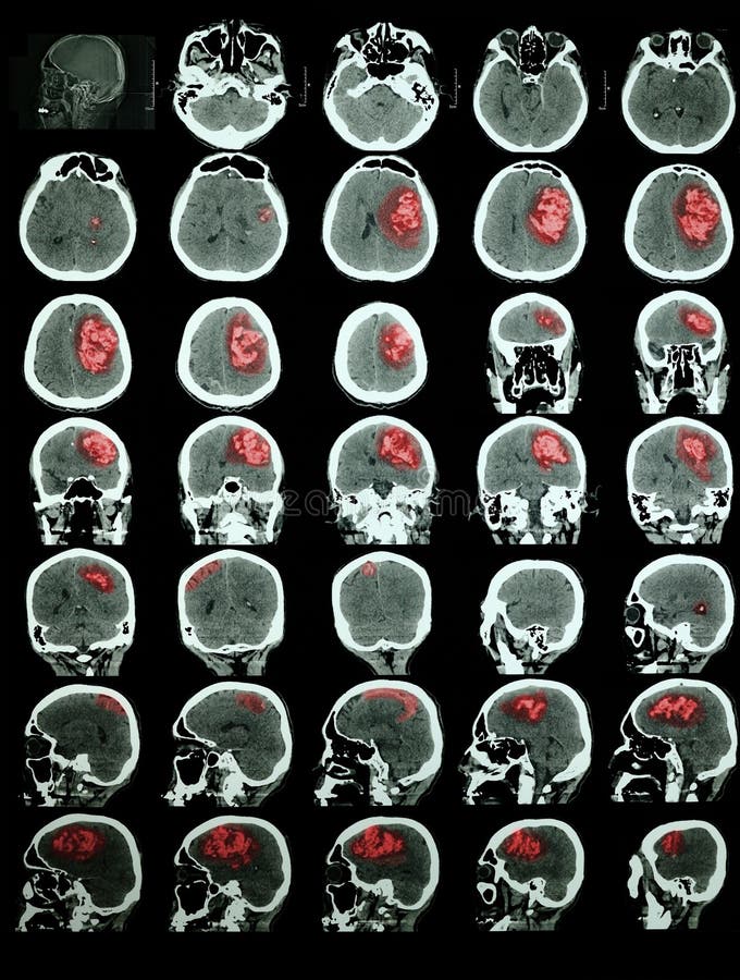 CT of the brain with hemorrhagic stroke. Professional training information. Red is highlighted the affected area