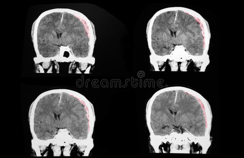 CT brain with large subdural hematoma. A traumatic brain injuried patient with large left subdural hematoma and moderate severe degree of brain edema royalty free illustration CT brain with large subdural hematoma. A traumatic brain injuried patient with large left subdural hematoma and moderate severe degree of brain edema royalty free illustration