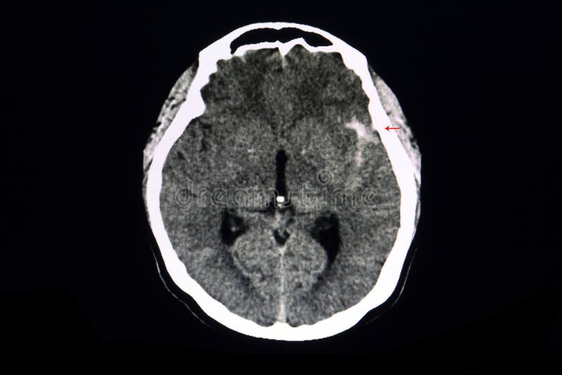 CT brain ruptured aneurysm