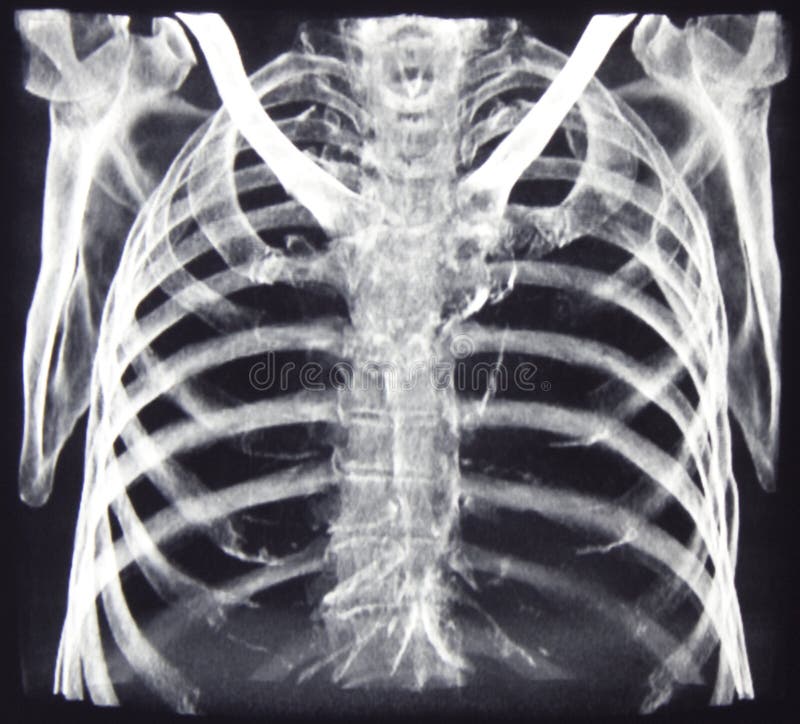 Bones of chest, CT reconstrution. Bones of chest, CT reconstrution