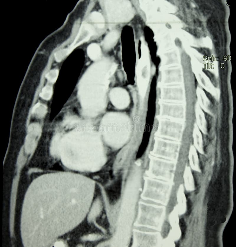 CT (computed Body Tomography) of Chest MSCT (multislice computed tomography) of chest and spine. CT (computed Body Tomography) of Chest MSCT (multislice computed tomography) of chest and spine