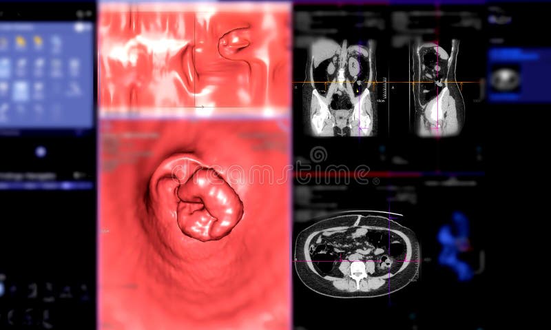 CT colonography 3D rendering stock illustration.