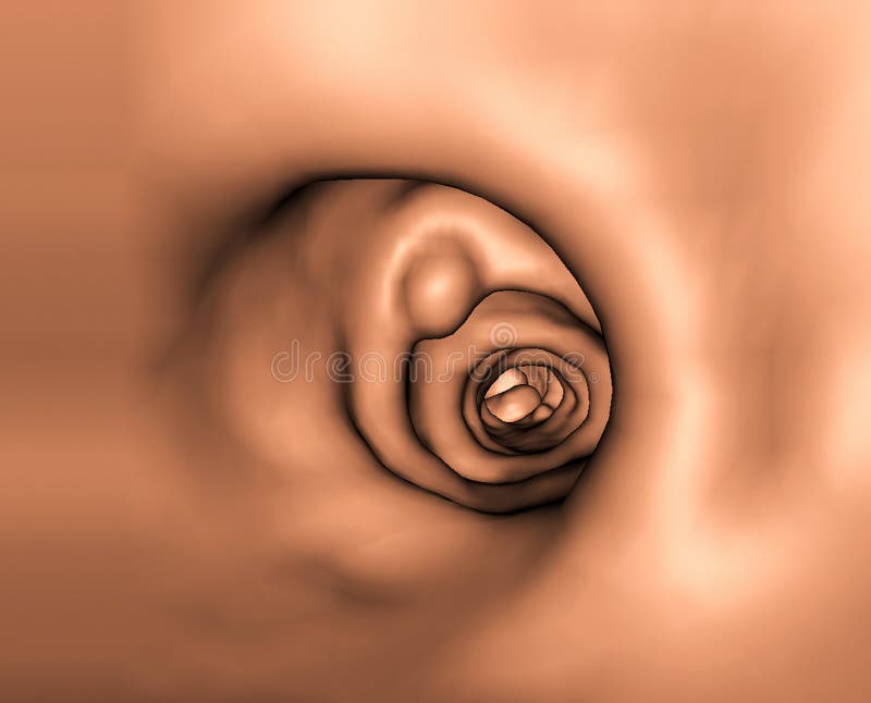 CT colonography, screening method, large bowel with small polyp. CT colonography, screening method, large bowel with small polyp