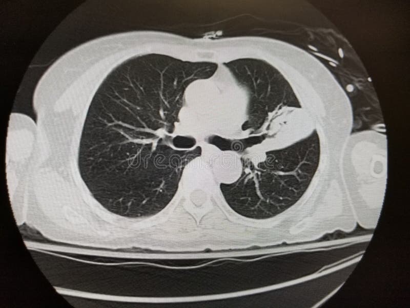 Left upper lobe pneumonia with Cryptococcus neoformans - CT scan royalty free stock photography
