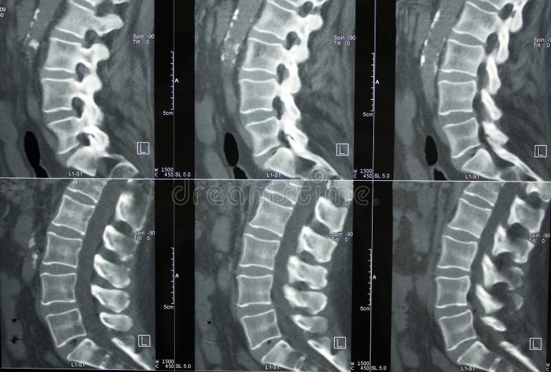 Computed Tomography of lumbar spine, lower back. Computed Tomography of lumbar spine, lower back