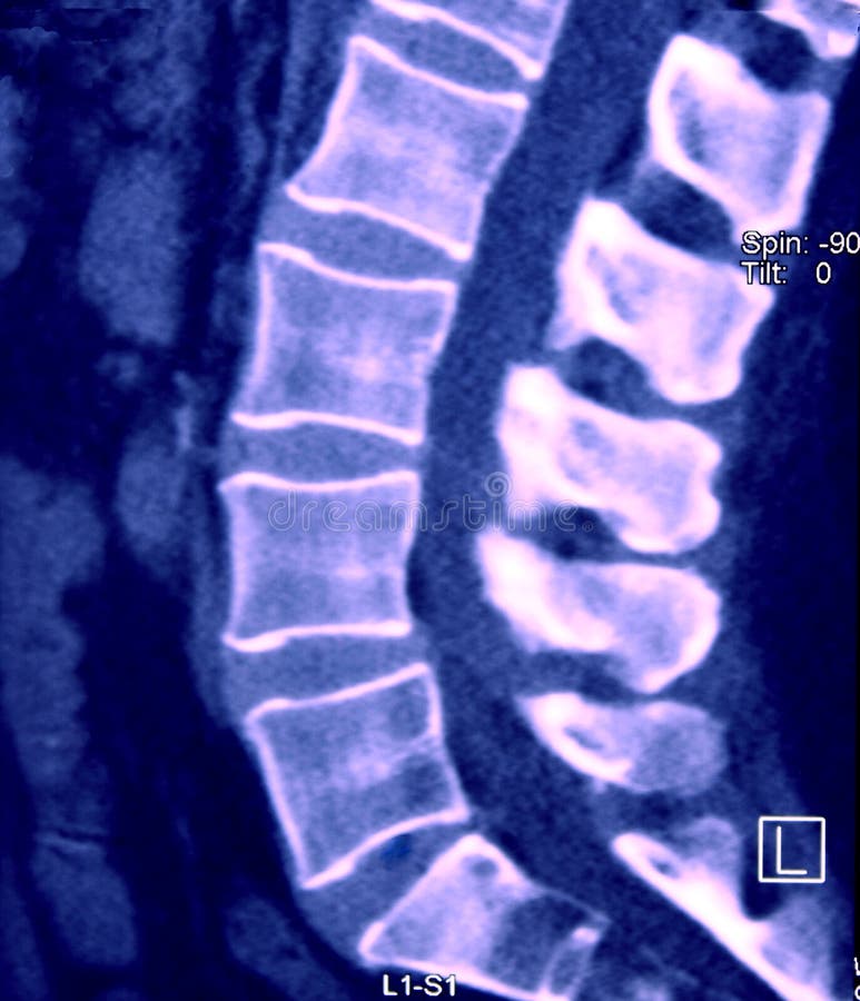 CT of Lumbar Spine, Sagittal plane, blue