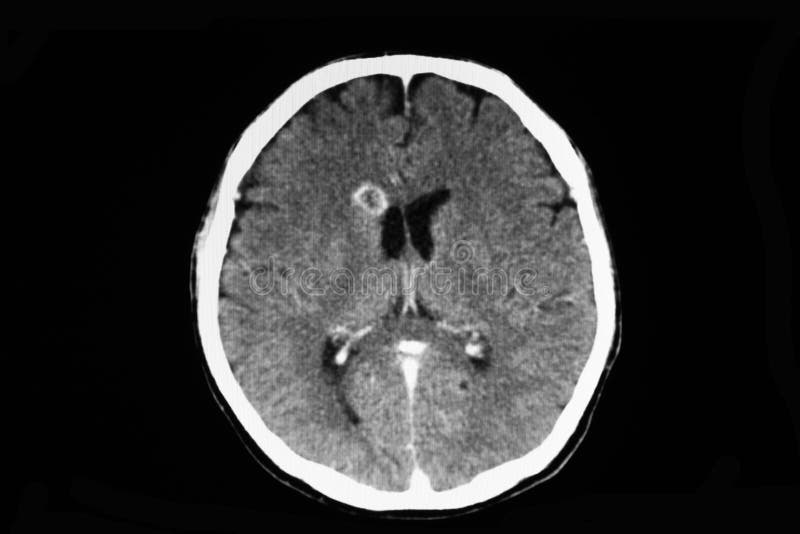 Image of a CT brain scan of a patient with severe headache showing a ring enhancing lesion or abscess at right caudate nucleus.  Possible diagnosis is tuberculoma, cysticercosis, or toxoplasmosis computer tomography xray film cerebral infection infectious hiv cerebrum nucleous serious background emergency urgency treatment human medicine medical white black hospital anatomy bone radiology radiologist disease edema neurology skull cranium diagnostic. Image of a CT brain scan of a patient with severe headache showing a ring enhancing lesion or abscess at right caudate nucleus.  Possible diagnosis is tuberculoma, cysticercosis, or toxoplasmosis computer tomography xray film cerebral infection infectious hiv cerebrum nucleous serious background emergency urgency treatment human medicine medical white black hospital anatomy bone radiology radiologist disease edema neurology skull cranium diagnostic