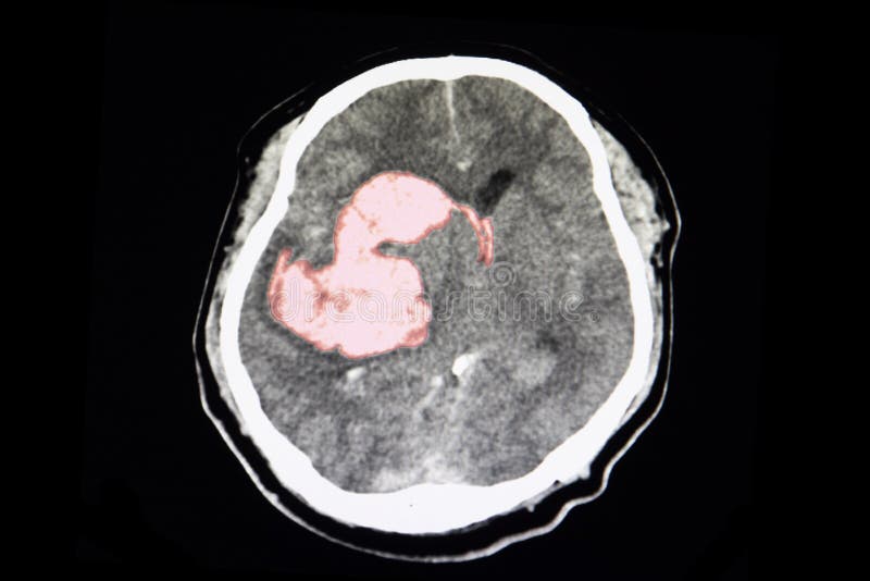 A CT scan of a stroke patient showing intracerebral hemorrhage in the Cd clots at  right thalamus, basal gangliconic and lateral ventricle with brain edema and shifting of flux celebri to the left. Severe hypertensive stroke, computer, tomography, xray, film, hypertension, cerebrum, massive, blood, bleeding, ganglion, ventricular, catastrophic, serious, diagnosis, background, neurosurgeon, doctor, emergency, urgency, treatment, surgery, human, image, medicine, medical, white, black, hospital, anatomy, bone, radiology, radiologist, disease, neurology, head, skull, cranium. A CT scan of a stroke patient showing intracerebral hemorrhage in the Cd clots at  right thalamus, basal gangliconic and lateral ventricle with brain edema and shifting of flux celebri to the left. Severe hypertensive stroke, computer, tomography, xray, film, hypertension, cerebrum, massive, blood, bleeding, ganglion, ventricular, catastrophic, serious, diagnosis, background, neurosurgeon, doctor, emergency, urgency, treatment, surgery, human, image, medicine, medical, white, black, hospital, anatomy, bone, radiology, radiologist, disease, neurology, head, skull, cranium