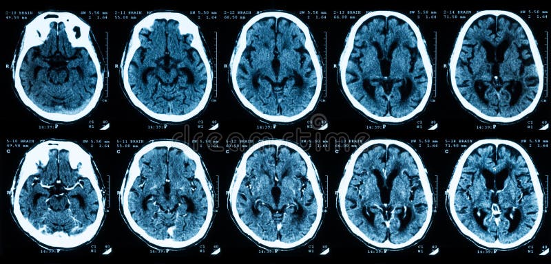 CT scan of brain, comparison between without and with contrast media. CT scan of brain, comparison between without and with contrast media.