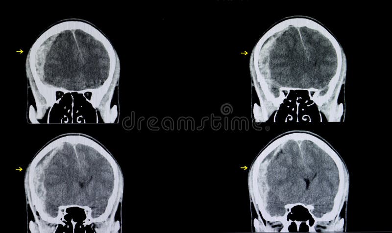 CT scan of a brain of a patient with traumatic head injury showing large subarachnoid hemorrhage in his right cerebral hemisphere with edema causing herniation of the tissue to the left side. CT scan of a brain of a patient with traumatic head injury showing large subarachnoid hemorrhage in his right cerebral hemisphere with edema causing herniation of the tissue to the left side.