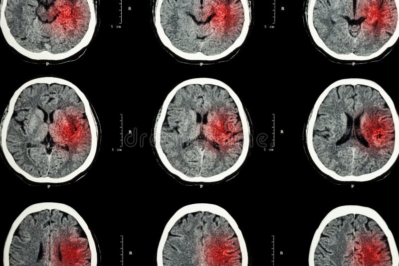 CT scan of brain with red area ( Imaging for hemorrhagic stroke or Ischemic stroke ( infarction ) concept )