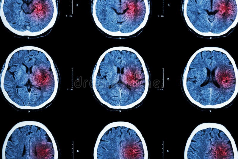 CT scan of brain with red area ( Imaging for hemorrhagic stroke or Ischemic stroke ( infarction ) concept )