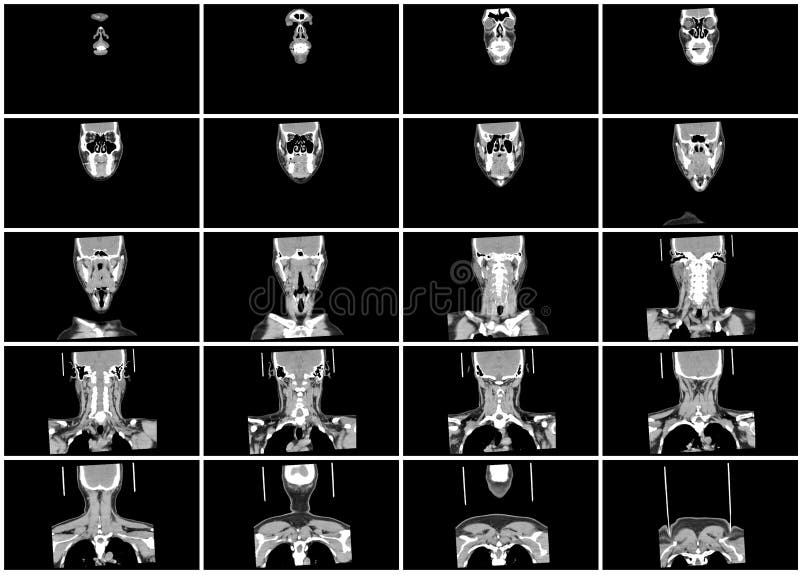 Ct Scan Step Set Of Body Lung Sagittal View Stock Photo Image Of