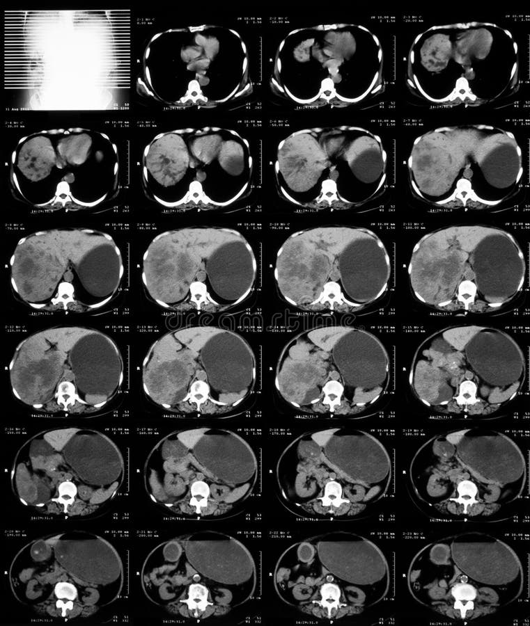 CT της ανώτερης κοιλίας στοκ εικόνες CT της ανώτερης κοιλίας στοκ εικόνες