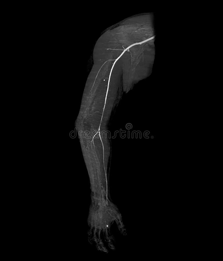 CTA Brachial Artery or CT Scan of Upper Extremity 3D Rendering Image