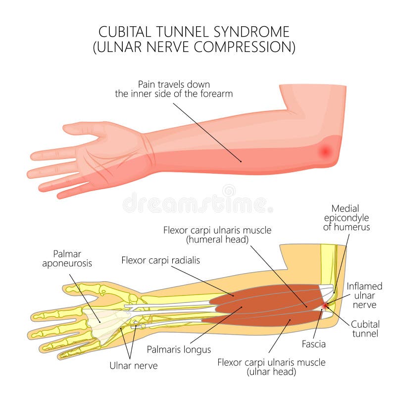 Cubital tunnel