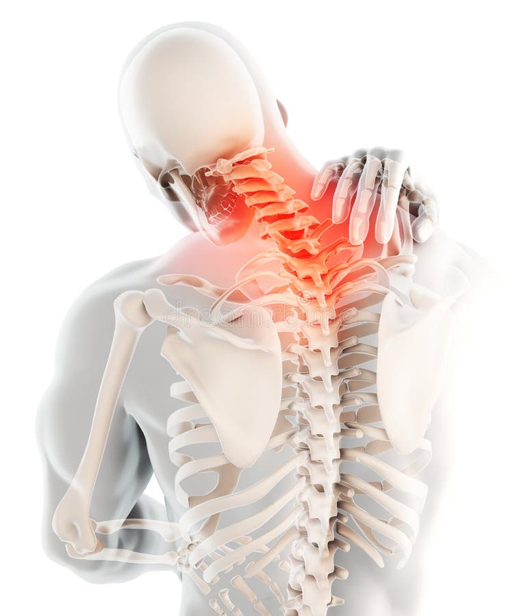 Cuello doloroso - radiografía esquelética de la espina dorsal cervical, ejemplo 3D