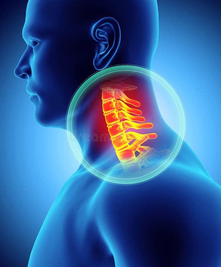Cuello doloroso - radiografía esquelética de la espina dorsal del cervica, ejemplo 3D