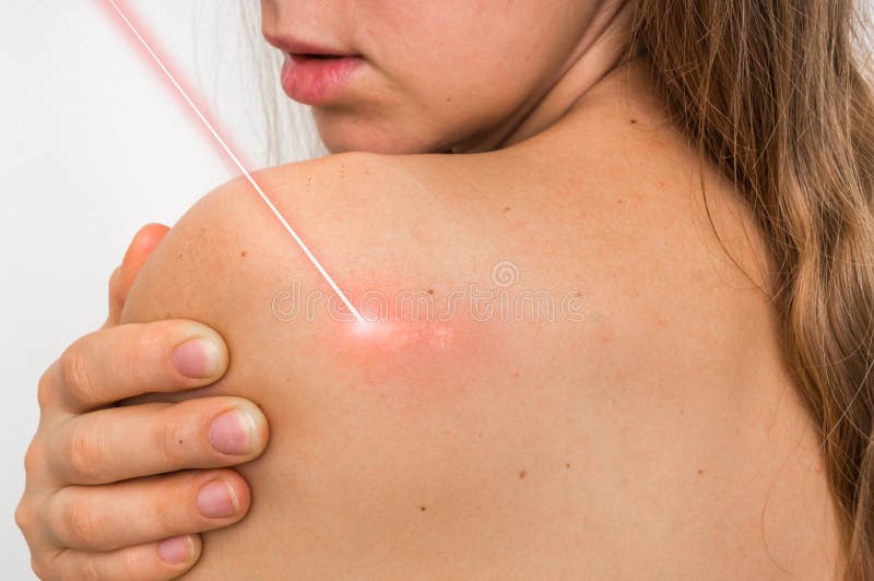 Cuerpo de la mujer y cirugía del laser foto de archivo Cuerpo de la mujer y cirugía del laser foto de archivo