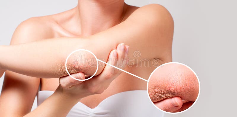 Cuidado do corpo A mulher tem a pele seca no cotovelo