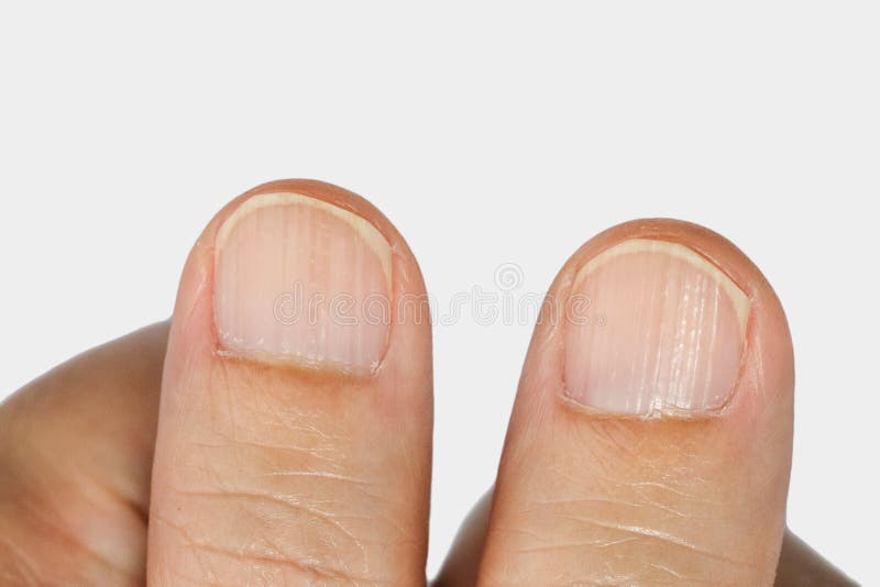 Cumes Verticais Nas Unhas Imagem De Stock Imagem De Vitamina 79514053 vertical-ridges-on-nails-causes-prevention-treatment