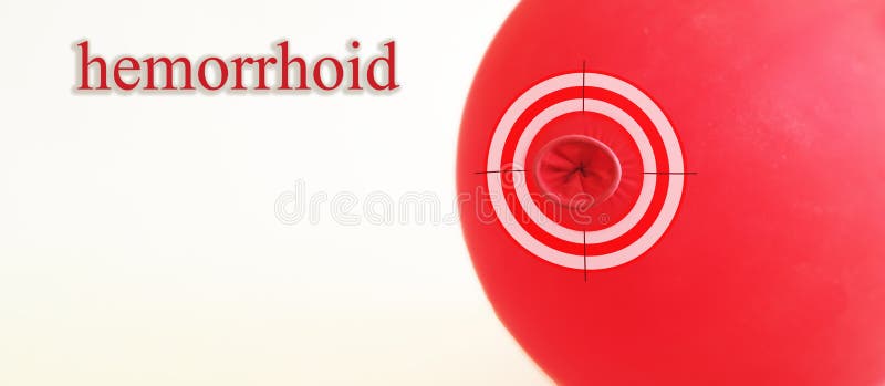 The Cure for Hemorrhoids Hits Exactly on Target. Hemorrhoid Treatment
