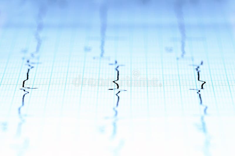 Patient's electrocardiogram on paper in the hospital. Patient's electrocardiogram on paper in the hospital