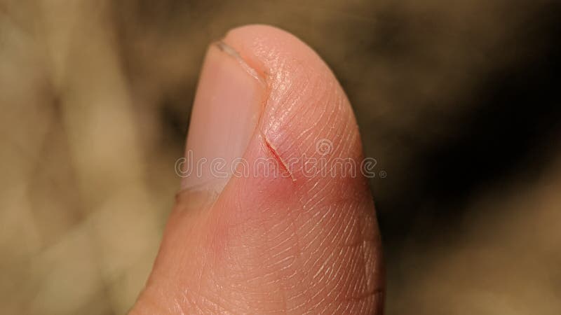 Bleeding Cut Finger Stock Photos Download 187 Royalty Free Photos