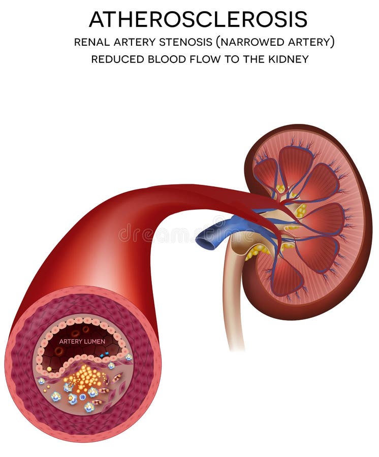 Cynaderki arterii choroba ilustracji Cynaderki arterii choroba ilustracji