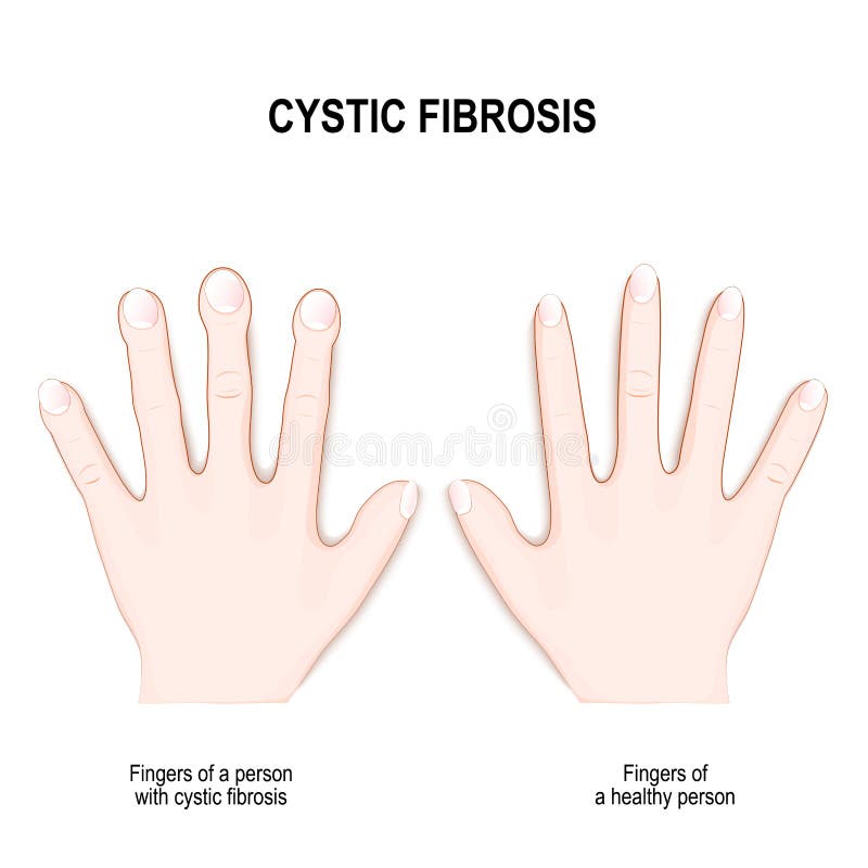 Cystic Fibrosis Nail Clubbing Symptoms Stock Illustration - Download Image  Now - Finger, Clubbing, Drumstick - iStock