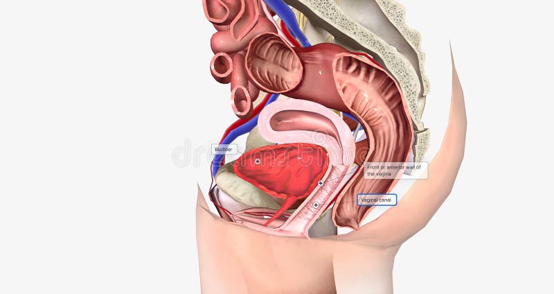 Stages of Uterine Prolapse. Pelvic Floor Muscles Weakening